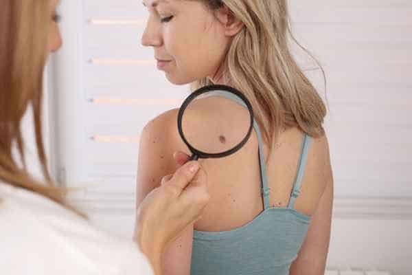 What Are Traditional Skin Lesion Removal Methods Croydon?