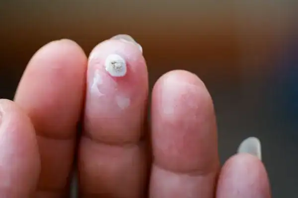 Image of white wart before cryopen treatment Croydon