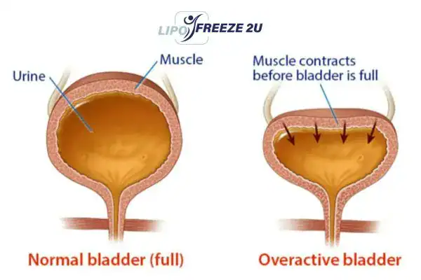diagram of overactive bladder treatment Croydon