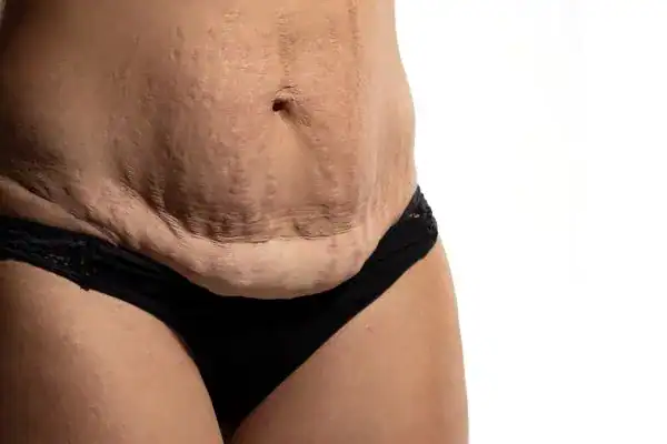 loose skin after weight loss injections Croydon