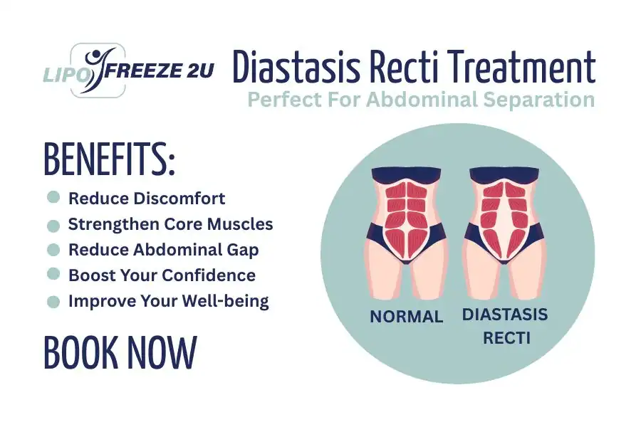 Benefits of body toning treatment Croydon for Diastasis recti