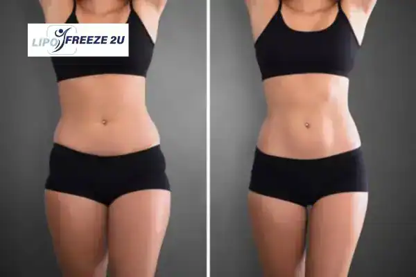 How Can LIPO FREEZE 2U Support Your Post-Pregnancy Body Recovery Croydon?