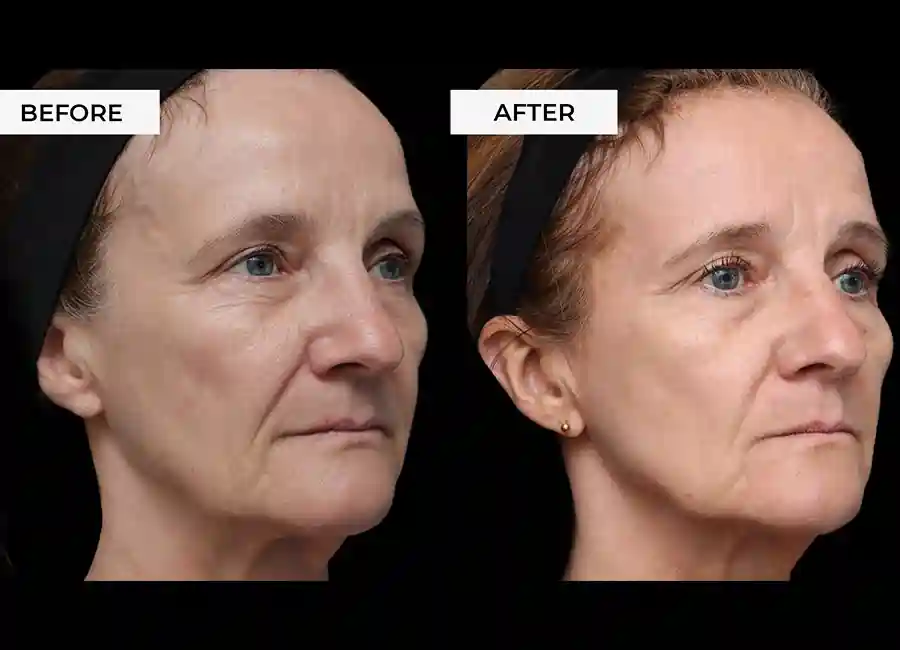 How Many RF Microneedling Sessions Will You Need to See a Difference Croydon?