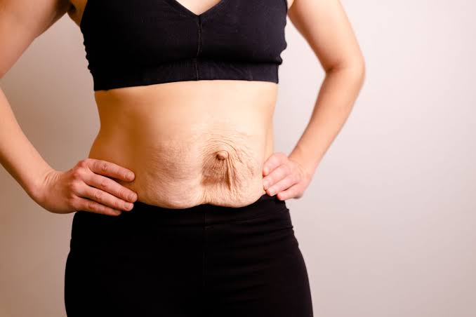 Is Surgery Really the Only Way to Repair Diastasis Recti Croydon?