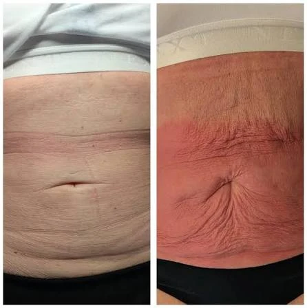 How Does RF Microneedling Improve Crepey, Thin and Uneven Skin Texture Croydon?