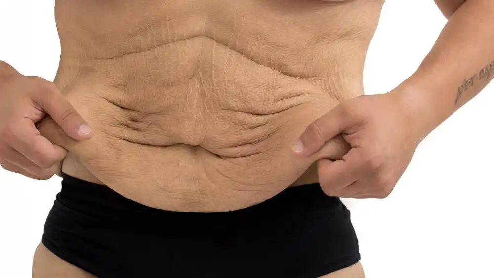 RF Microneedling for Loose Skin: How Can It Help Tighten and Reshape the Skin Croydon?